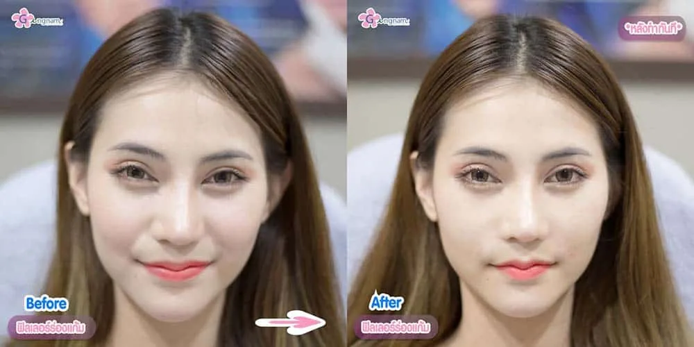 ฉีดฟิลเลอร์ร่องแก้ม เหมาะกับใคร ฉีดที่ไหนดี เติมบ่อยต้องอ่าน