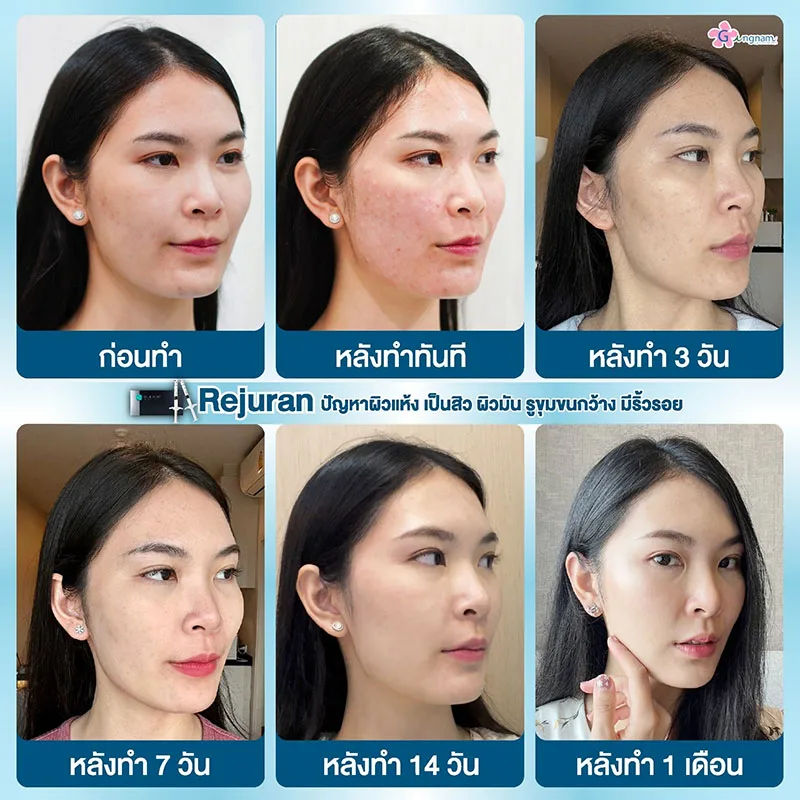 ฉีด rejurun ให้ผิวฉ่ำวาว หน้าอิ่มน้ำ