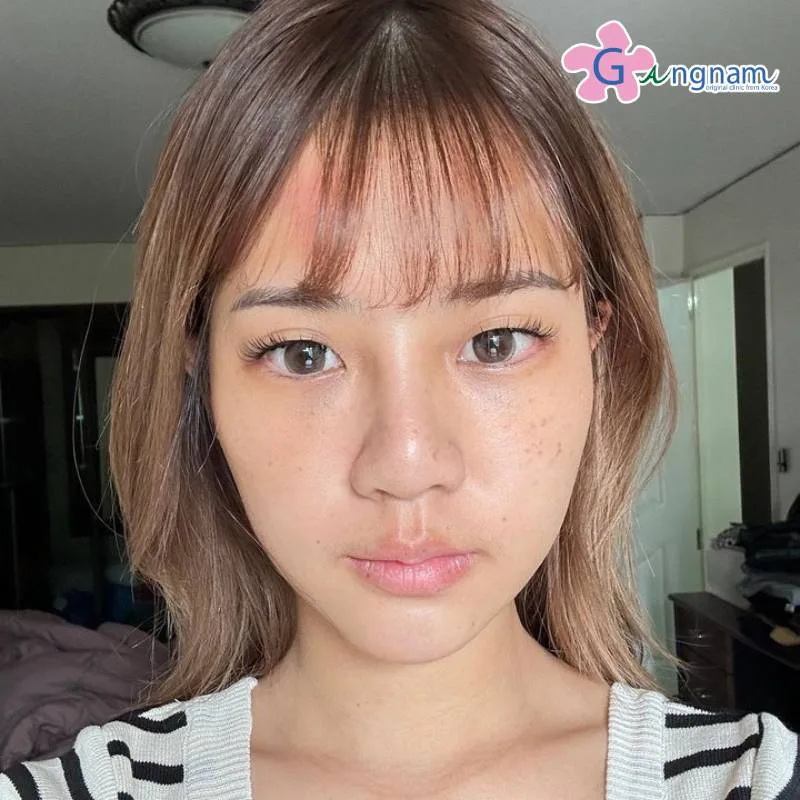 คุณแพร หลังทำ 3 วัน