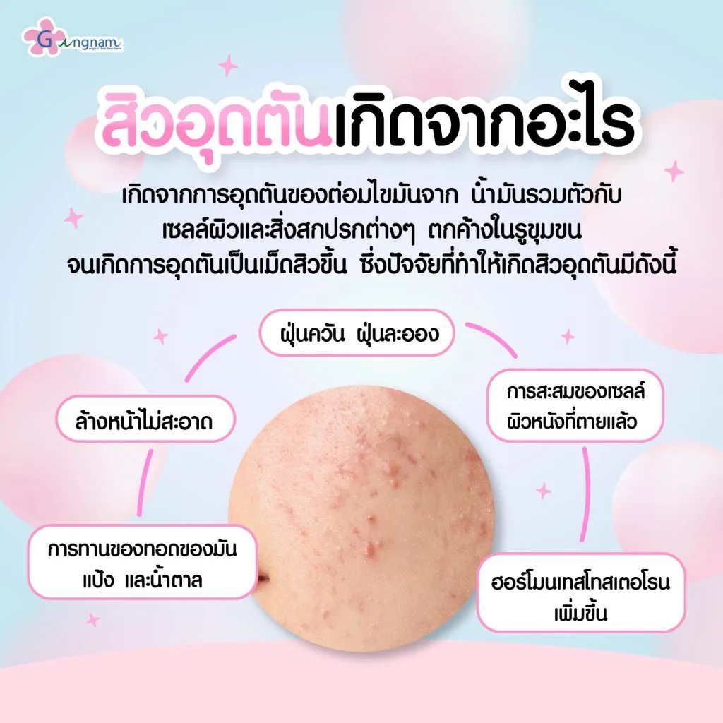 สิวอุดตันเกิดจากอะไร