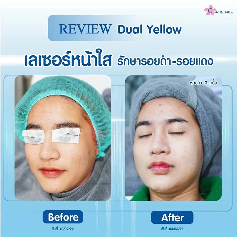 Dual Yellow laser รักษารอยดำ รอยแดง
