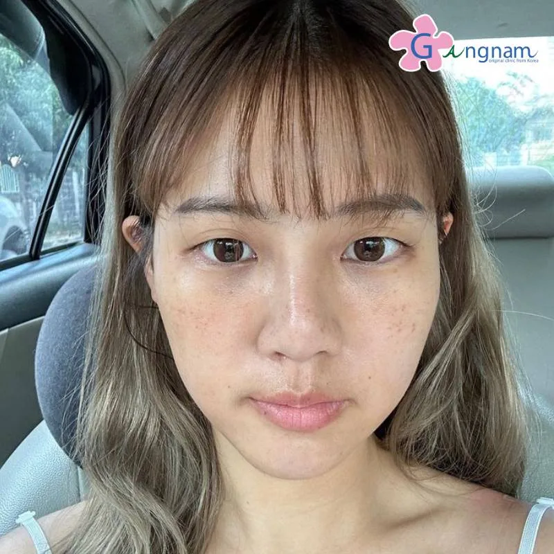 คุณแพร หลังทำ 14 วัน