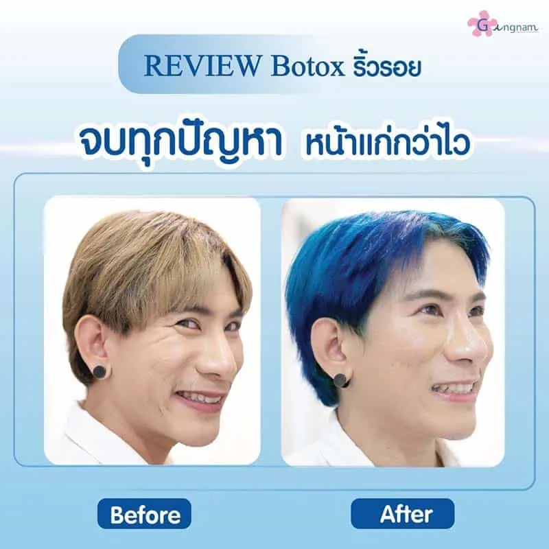 รีวิวโบท็อกหาง รอยดูจางลดลง