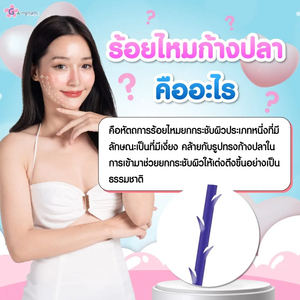 ร้อยไหมก้างปลาคืออะไร