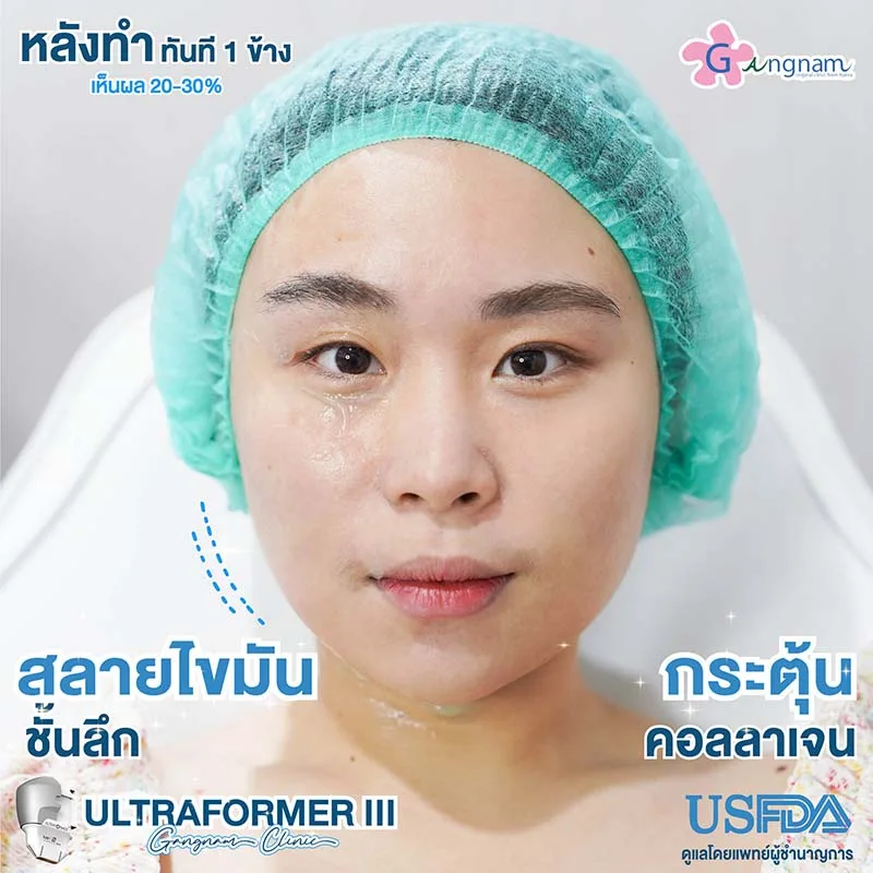 ultraformer กี่วันเห็นผล