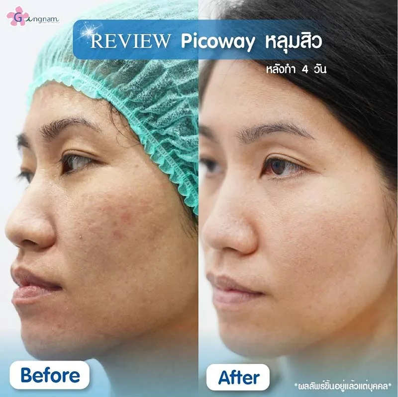 pico laser หลุมสิว