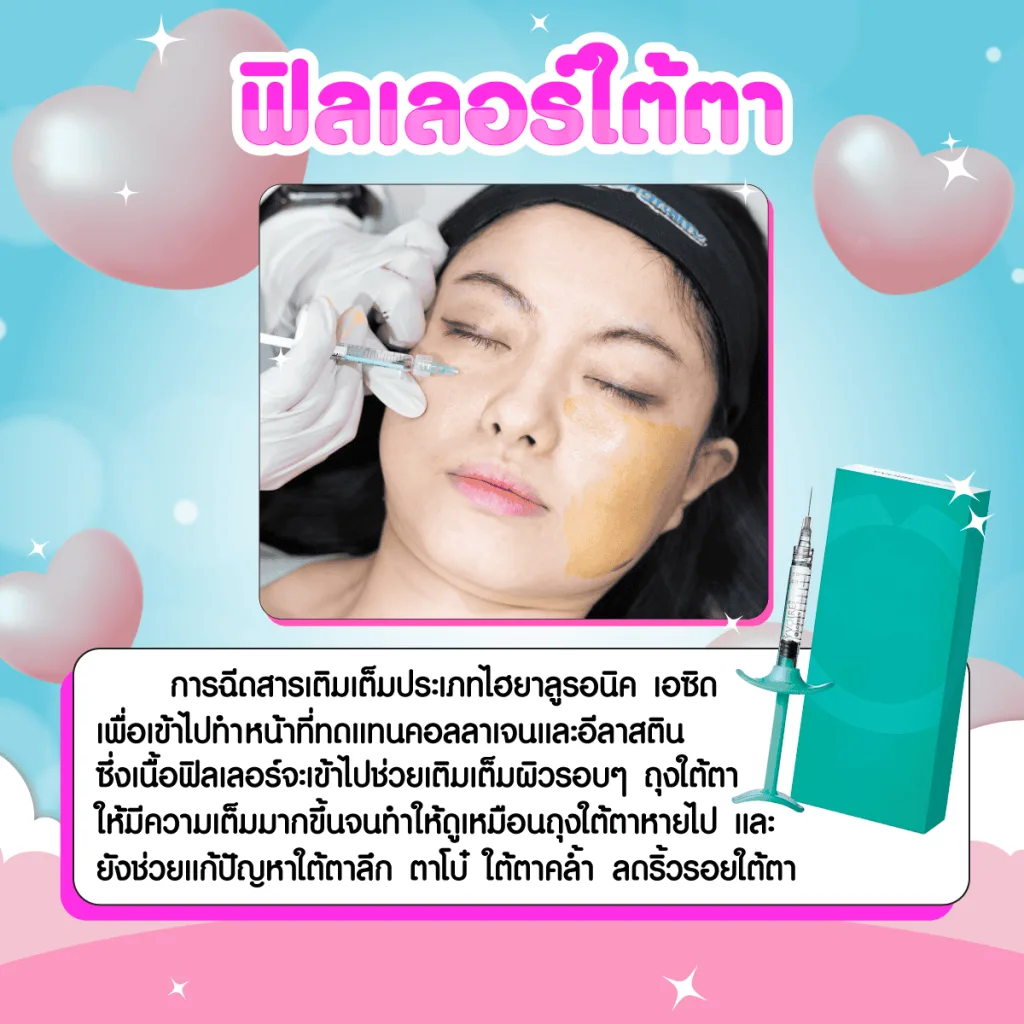 ลดถุงใต้ตาด้วยฟิลเลอร์
