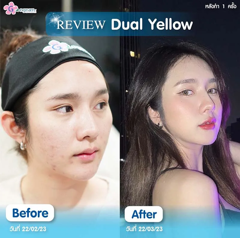 หลังทำ dual yellow laser 1 ครั้ง