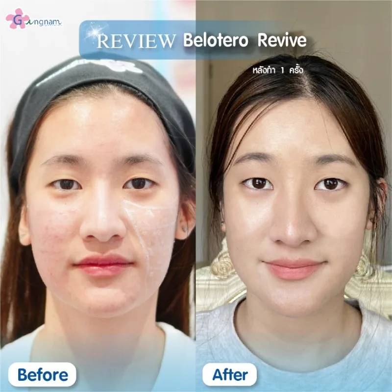 รีวิว Belotero Revive