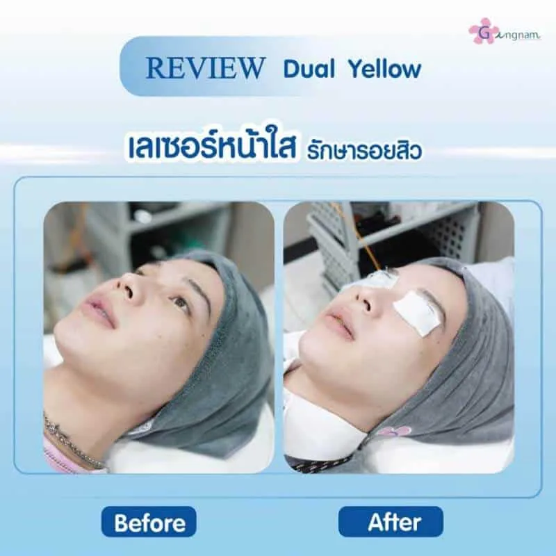 รีวิวเลเซอร์หน้าใส ลดริ้วรอย