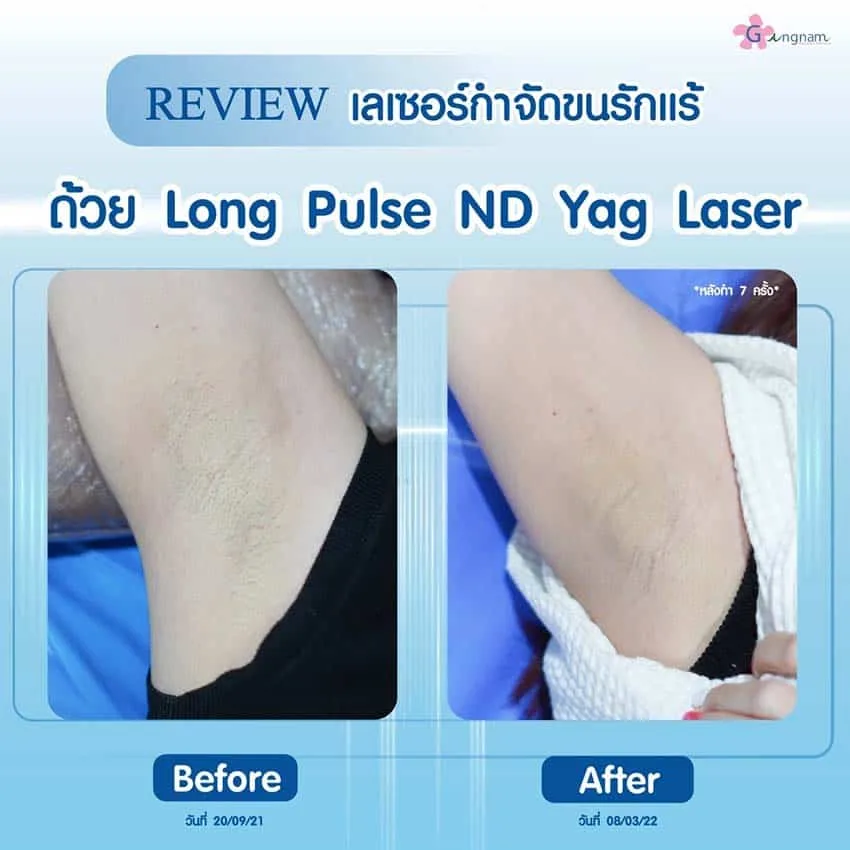 รีวิวเลเซอร์รักแร้-หลังทำ-7-ครั้ง