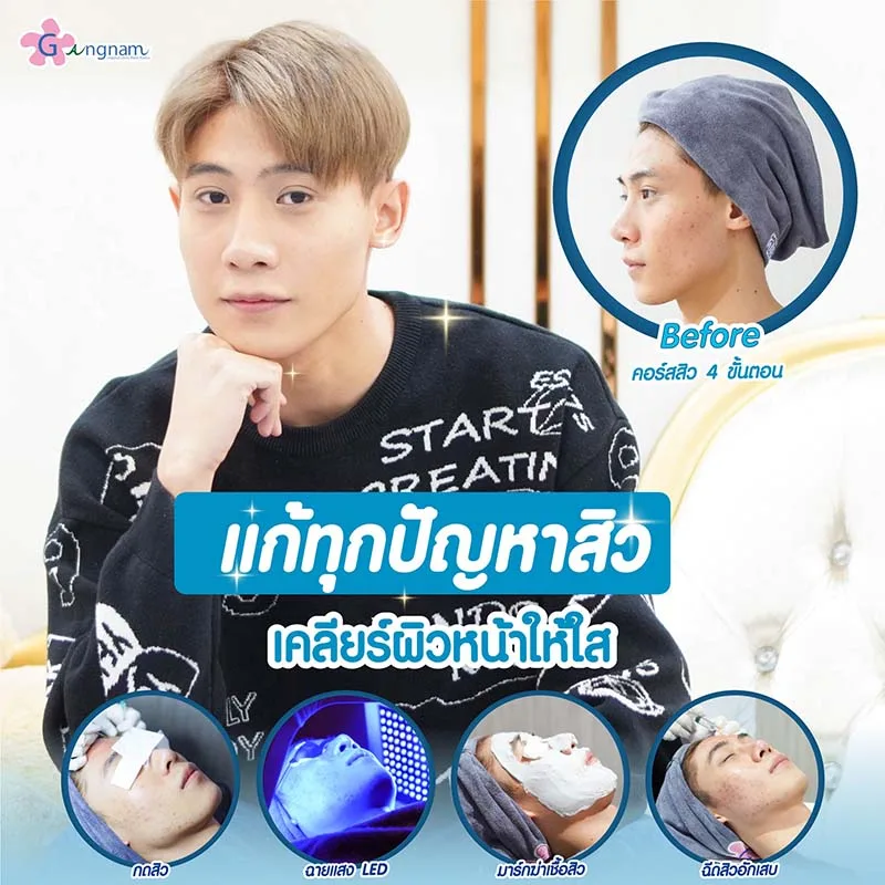 รักษาสิวที่หน้าผากที่ไหนดี