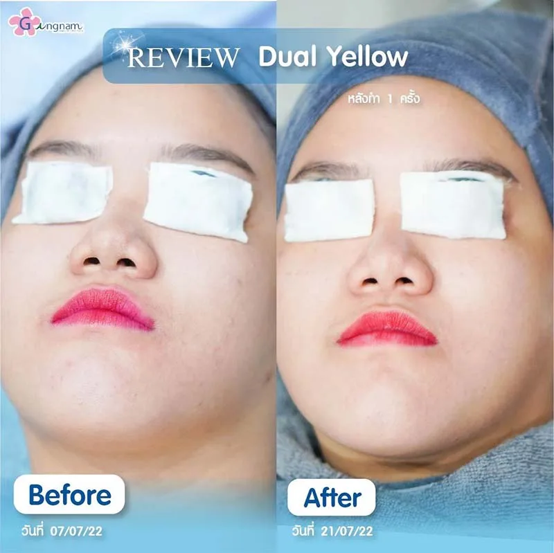 รีวิวเลเซอร์รักษาสิวแพ้แมส