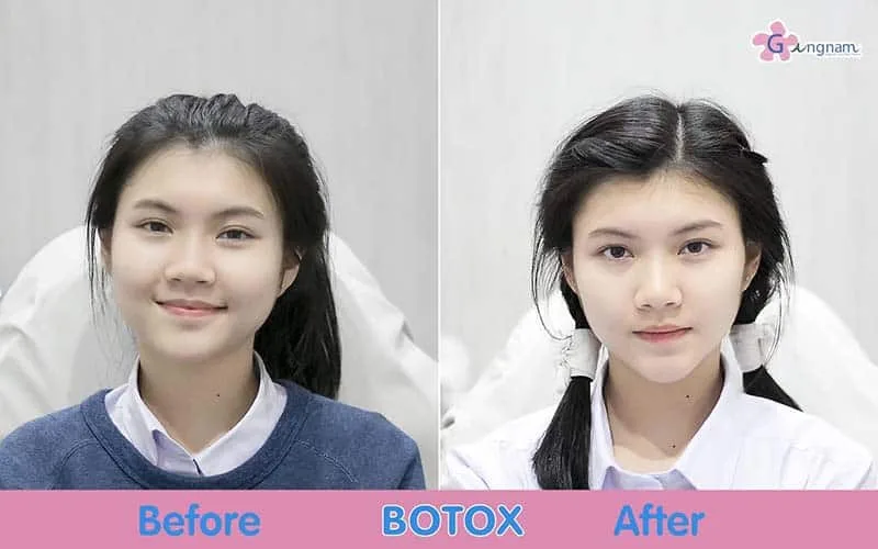 รีวิว ฉีดโบท็อกลดกราม