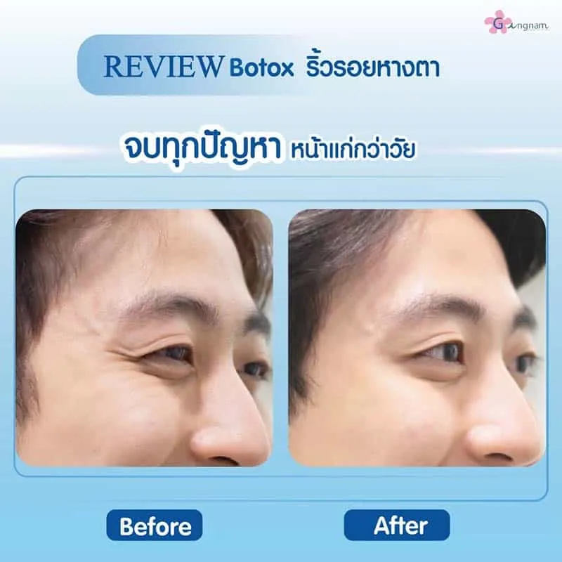รีวิวโบท็อกหางตา ผู้ชาย