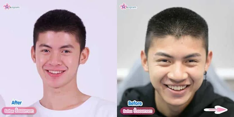 รีวิวหลังทำโบท็อกหางตา