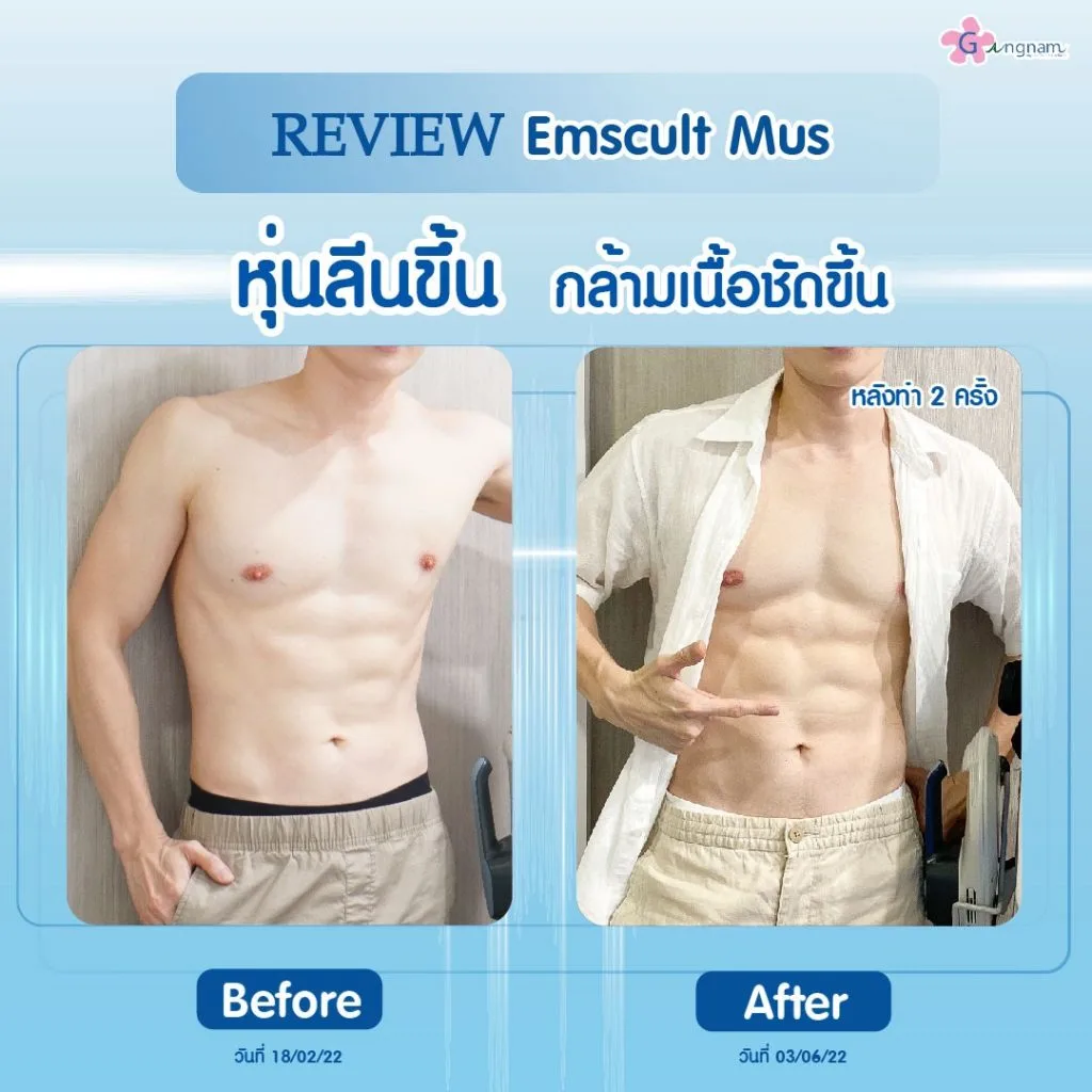 เครื่อง Emsculpt mus ต้องทำบ่อยไหม