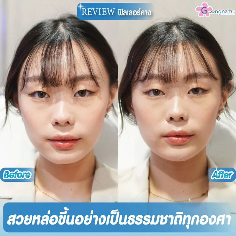 การฉีดฟิลเลอร์คาง ข้อดี ข้อเสีย ช่วยอะไร