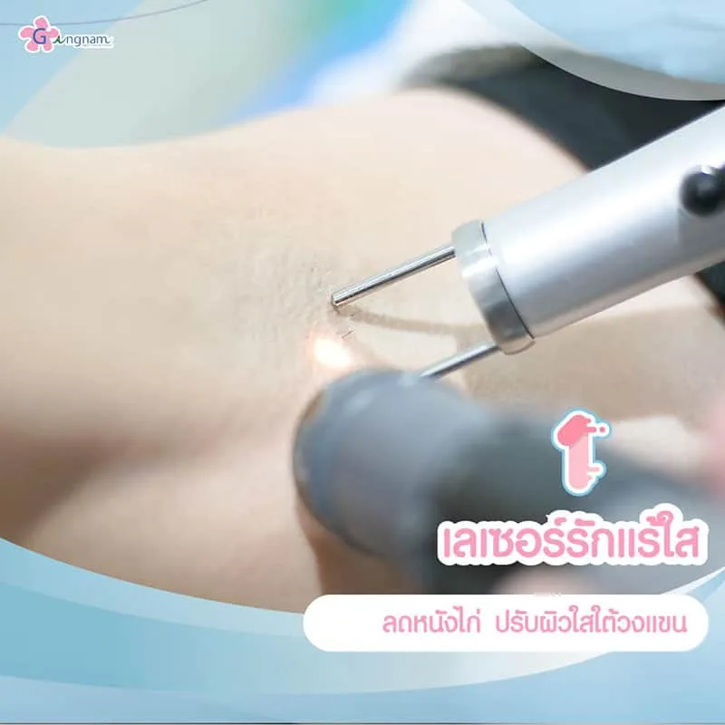 เลเซอร์ปรับผิวใต้วงแขน