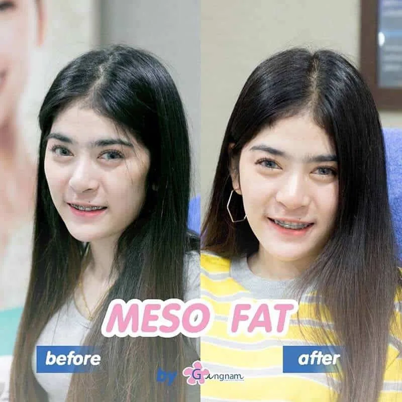 รีวิว Before After หลังฉีดแฟต