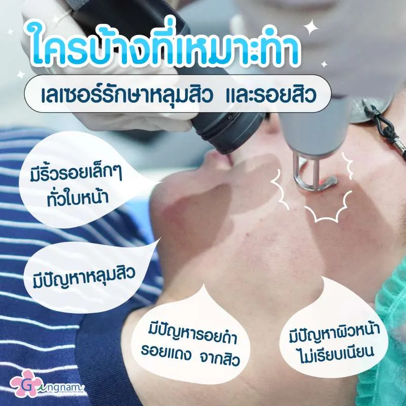 เลเซอร์รักษาหลุมสิว และรอยสิวเหมาะกับใคร