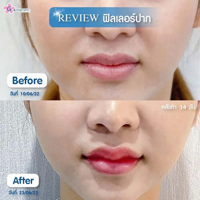 การฉีดฟิลเลอร์ปาก ช่วยเรื่องอะไรบ้าง