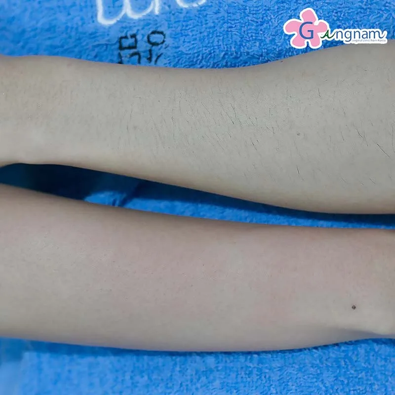 หลังทำเลเซอร์ขนแขน