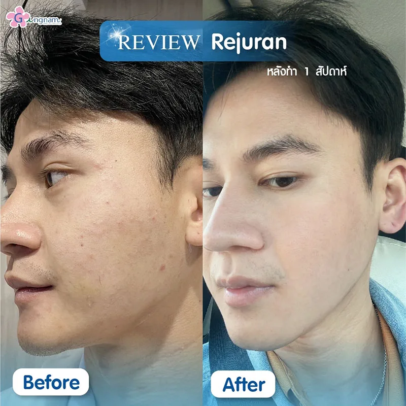 รีวิวการฉีด rejuran ในผู้ชาย