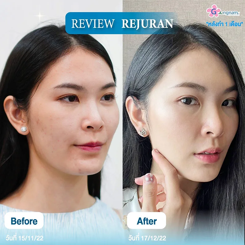 ฉีด rejuran ปรับผิวหน้าเรียบเนียนรูขุมขนกระชับ