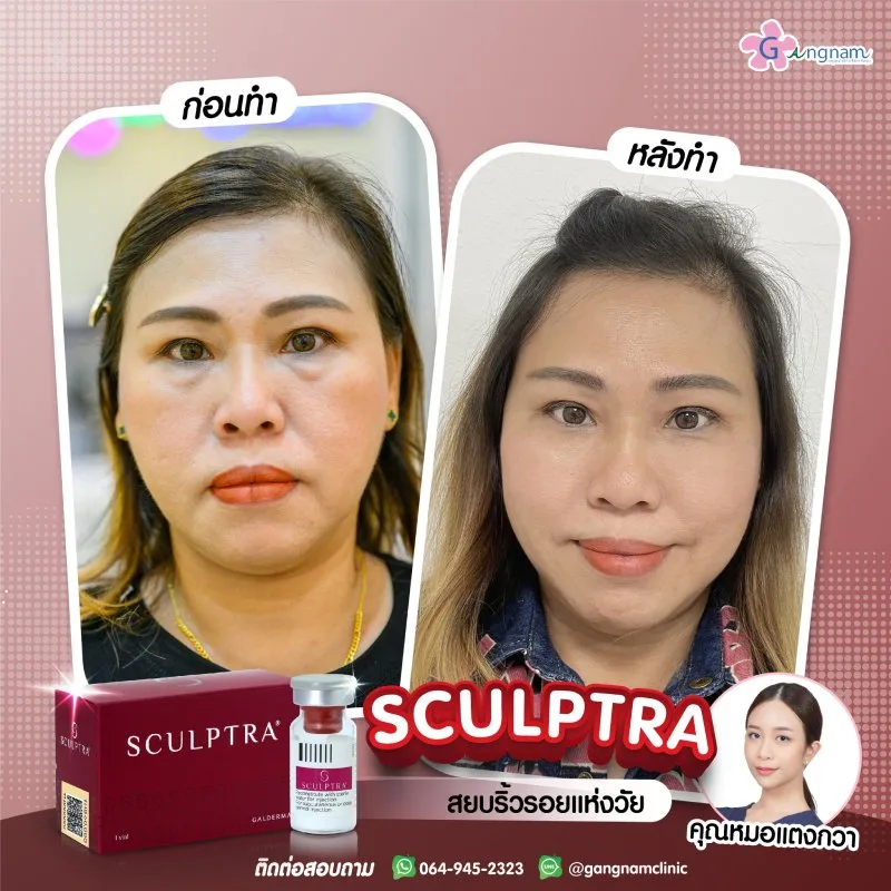 ผลลัพธ์หลังทำ Sculptra
