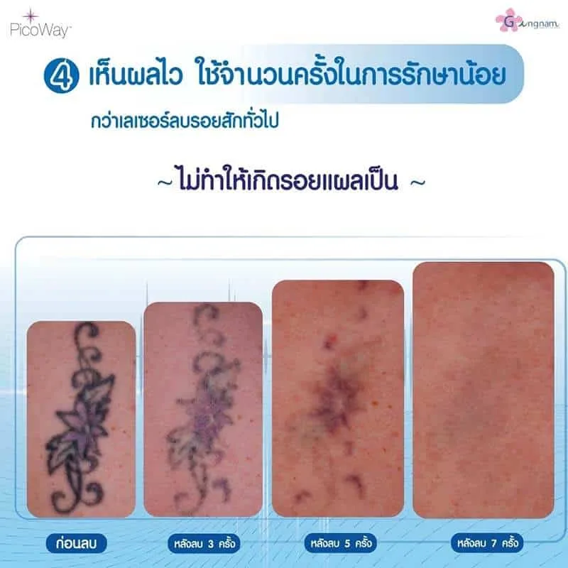 ใช้จำนวนครั้งในการลบรอยสักน้อย