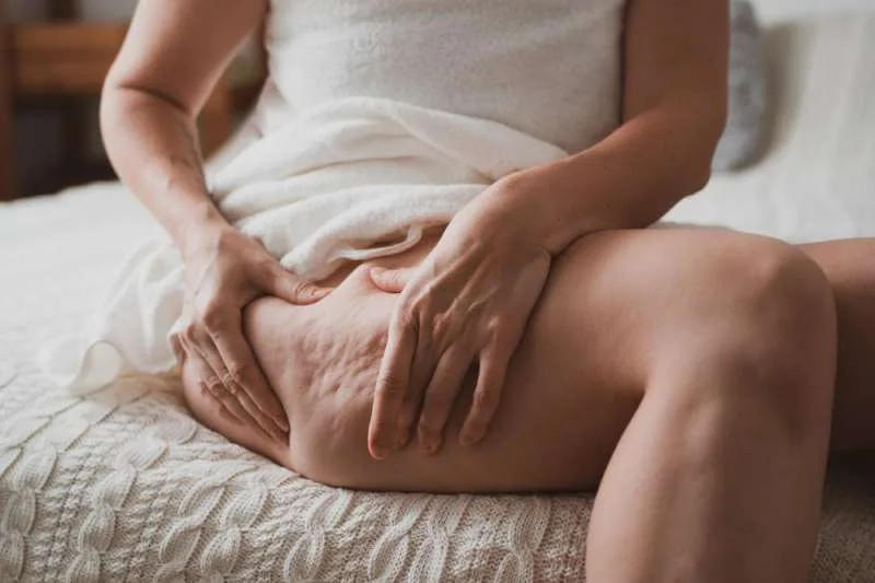 เซลลูไลท์ (Cellulite) ที่ต้นขา_