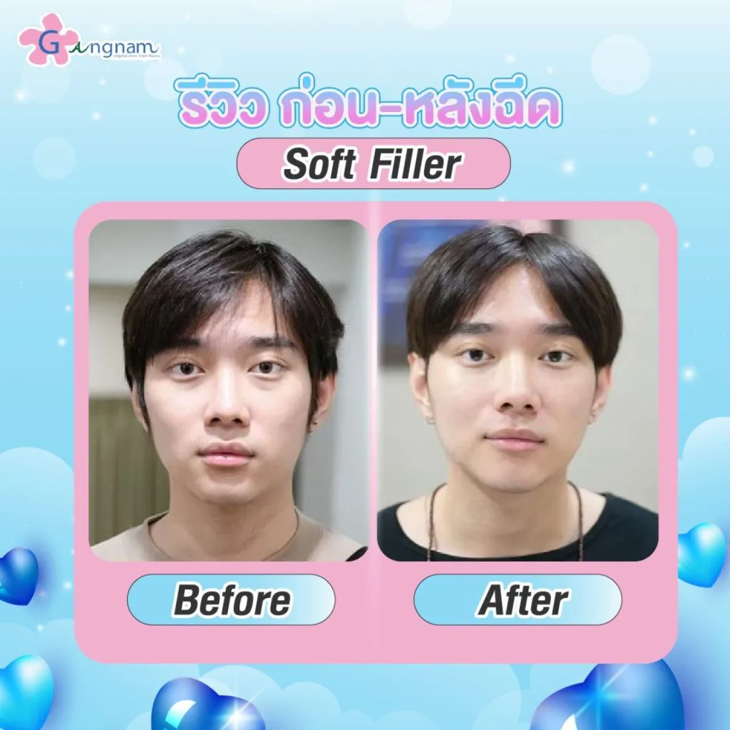 รีวิวsoft filler