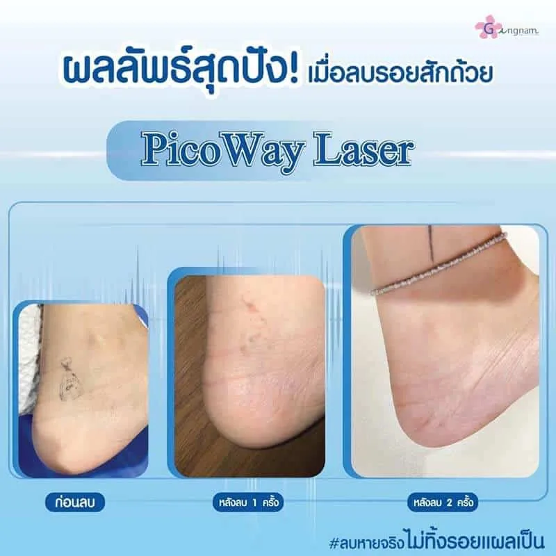 รีวิวลบรอยสักข้อเท้า