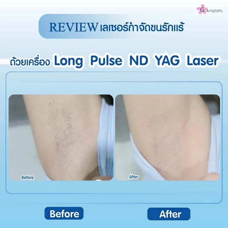 รีวิวเลเซอร์ขนรักแร้ ขนดูบางลง