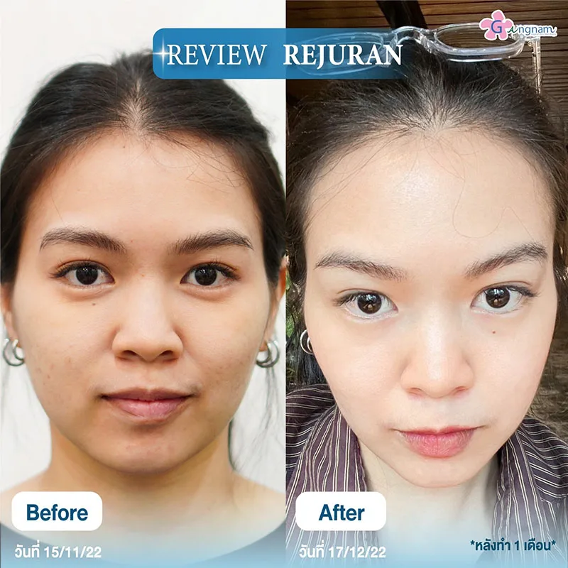 รีวิวฉีด rejuran