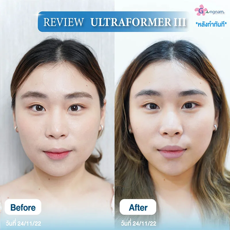 รีวิว Ultraformer 3