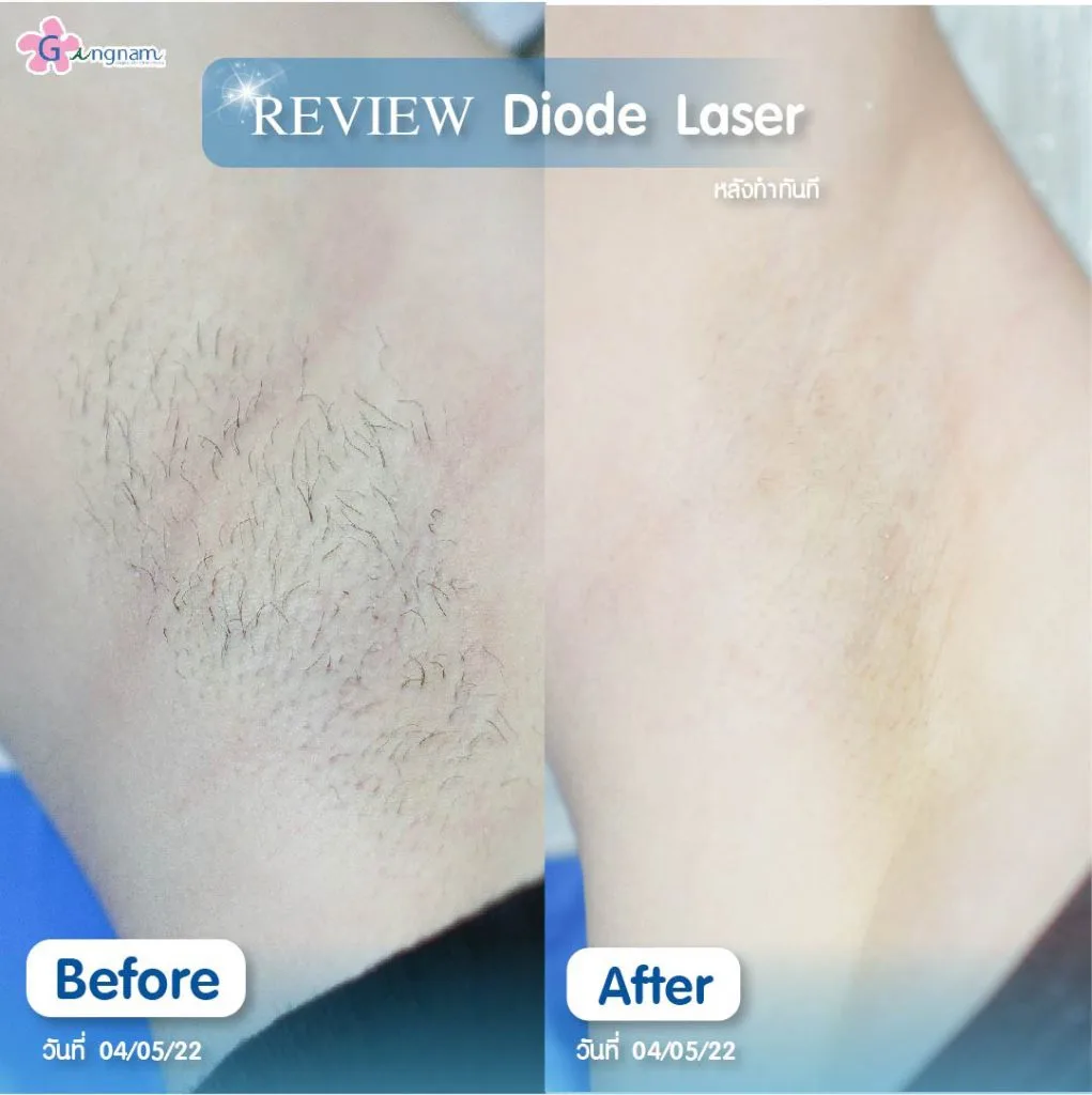 รีวิวหลังทำ Diode Laser