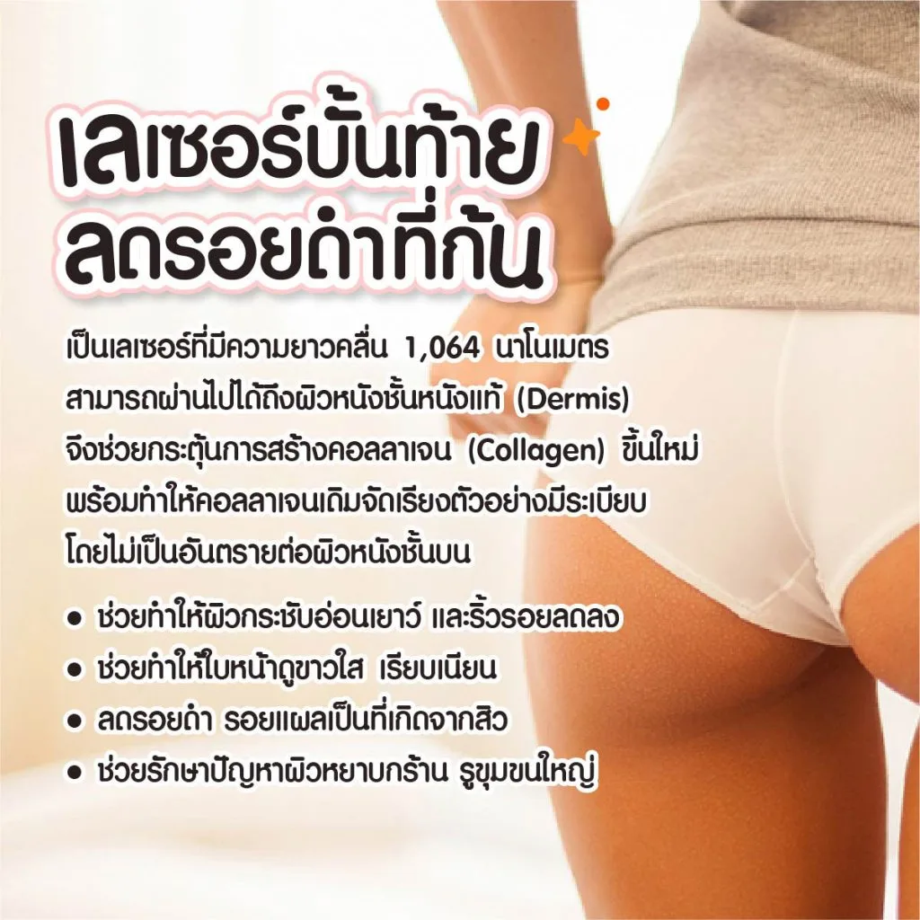 เลเซอร์แก้ ก้นดำ ก้นลาย