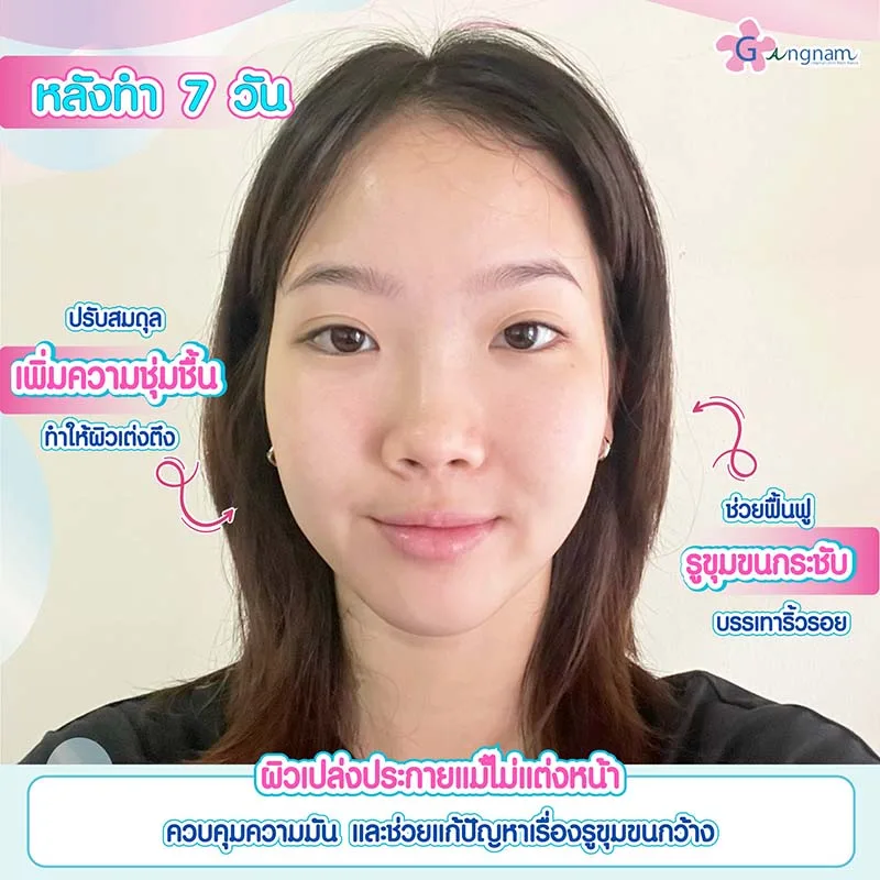ฉีด Chanel ให้ผิวกระจ่างใสขึ้น