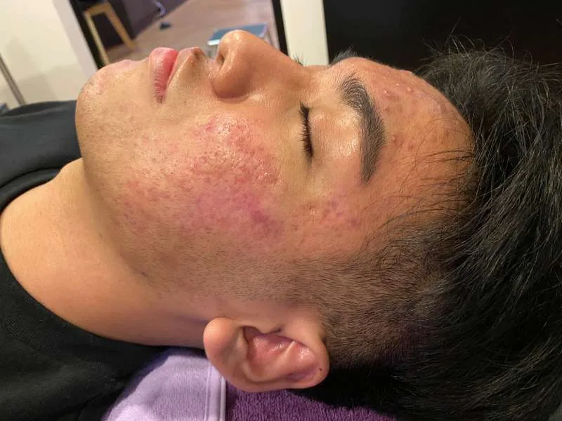 คุณมีหลุมสิวเป็นแบบไหนกันนะ