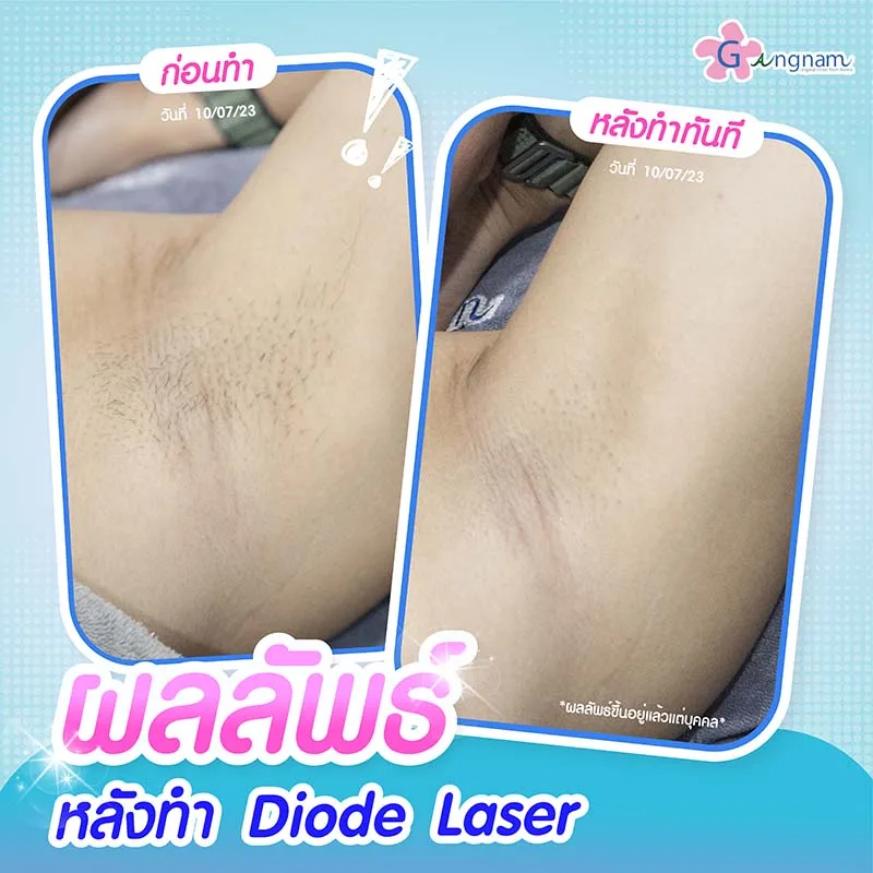 หลังทำ diode laser ครั้งแรก