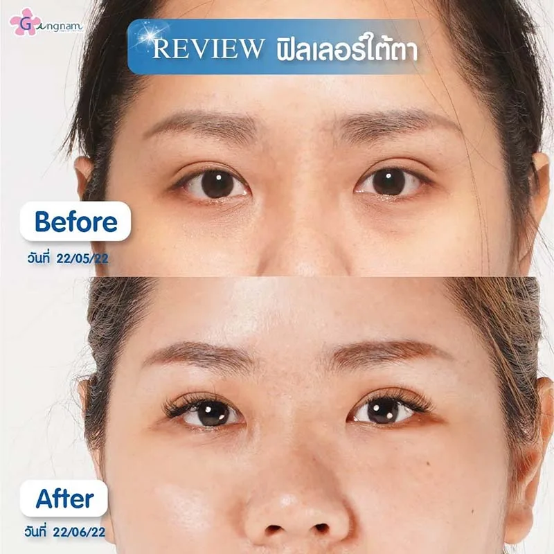 การฉีดฟิลเลอร์ใต้ตา เหมาะกับใคร