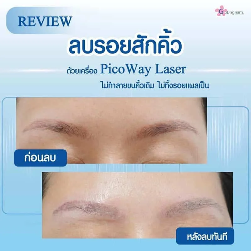 รีวิวเลเซอร์ลบรอยสักคิ้ว