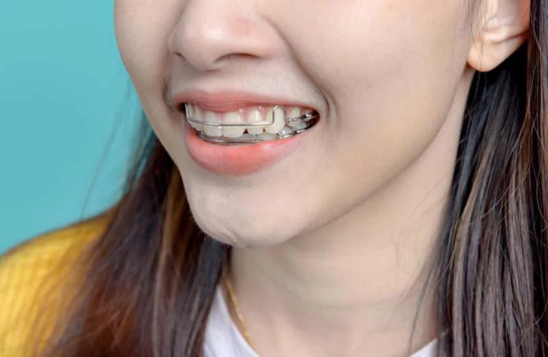 การจัดฟันลดกราม