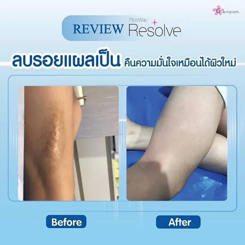 รีวิวลบรอยแผลเป็นนูน