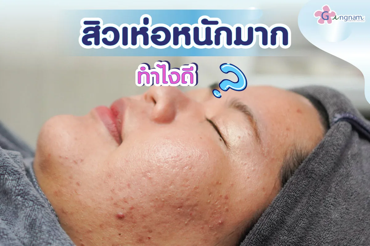 สิวเห่อหนักมาก ทำไงดี? สาเหตุเกิดจากอะไร มีวิธีรักษาให้หายได้อย่างไร?
