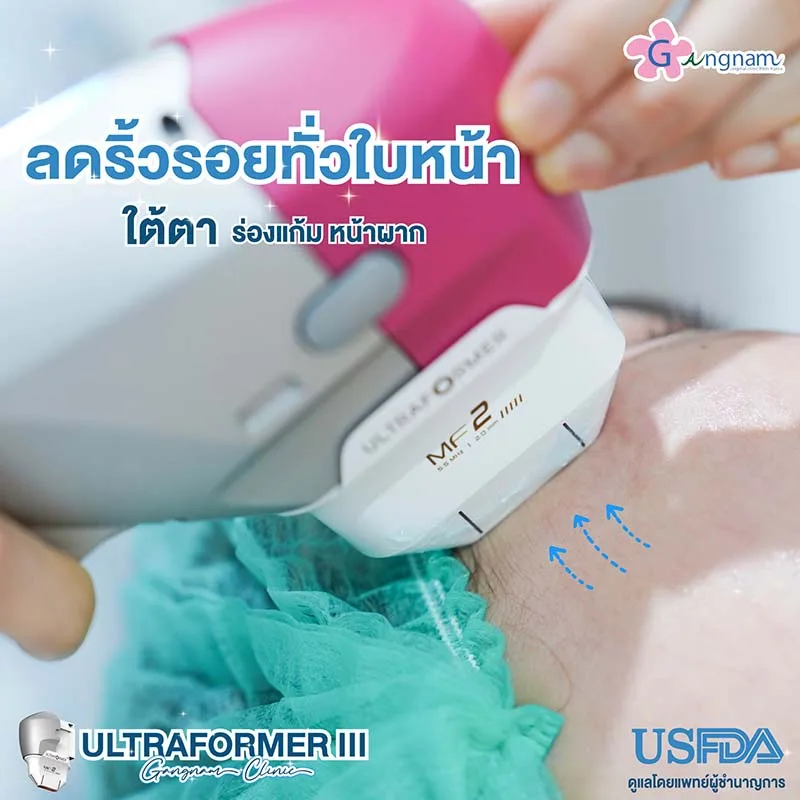 ultraformer-iii ช่วยยกกระชับลดริ้วรอย จุดไหนบ้าง