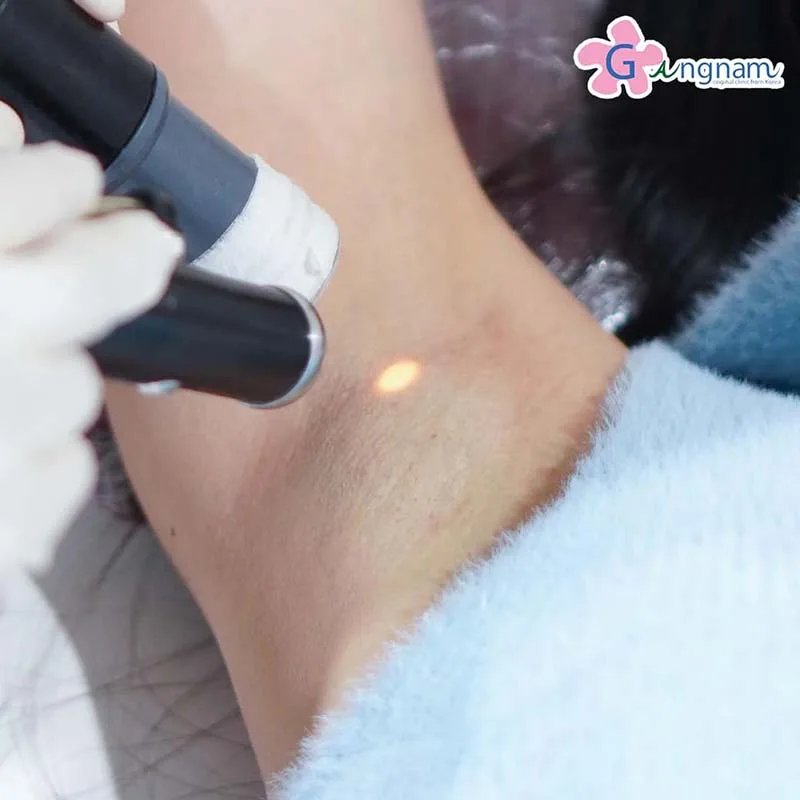 ทำเลเซอร์รักแร้ ด้วย Long Pulse ND YAG