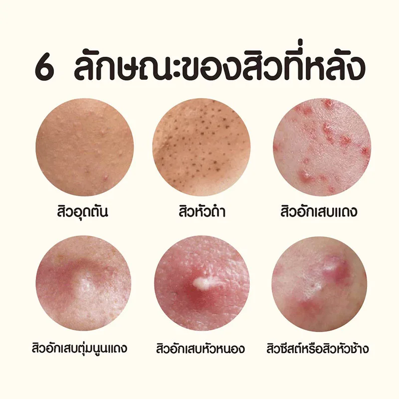 ลักษณะของสิวที่หลัง